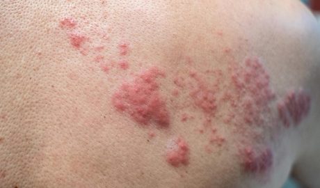 Herpes Zòster