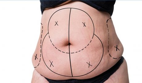 Preparació per a la liposucció