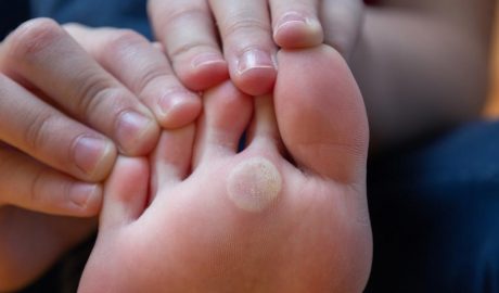 Hiperqueratosi en un peu