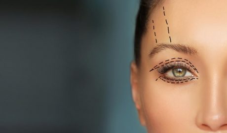 Una dona que es vol sotmetre a una blefaroplàstia
