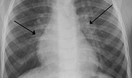 Radiografia d'una persona amb bronquiolitis
