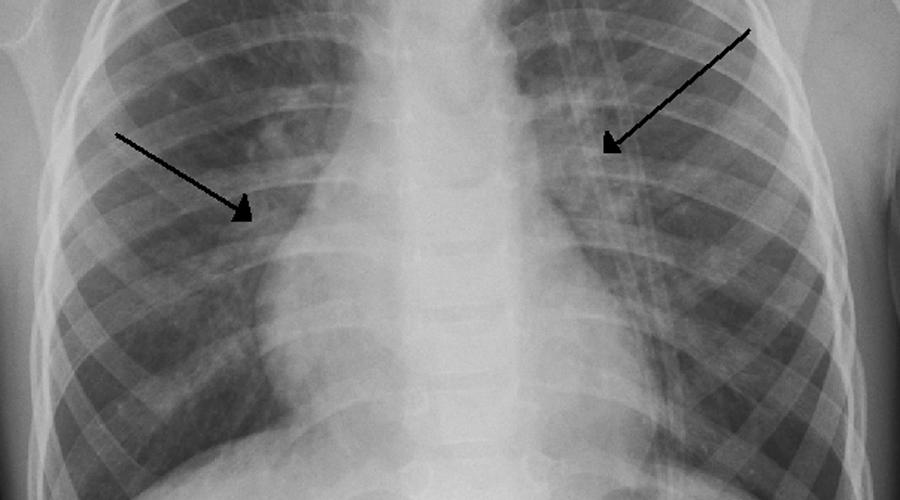 Radiografia d'una persona amb bronquiolitis