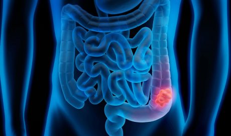 Infografia simulant un càncer de colon