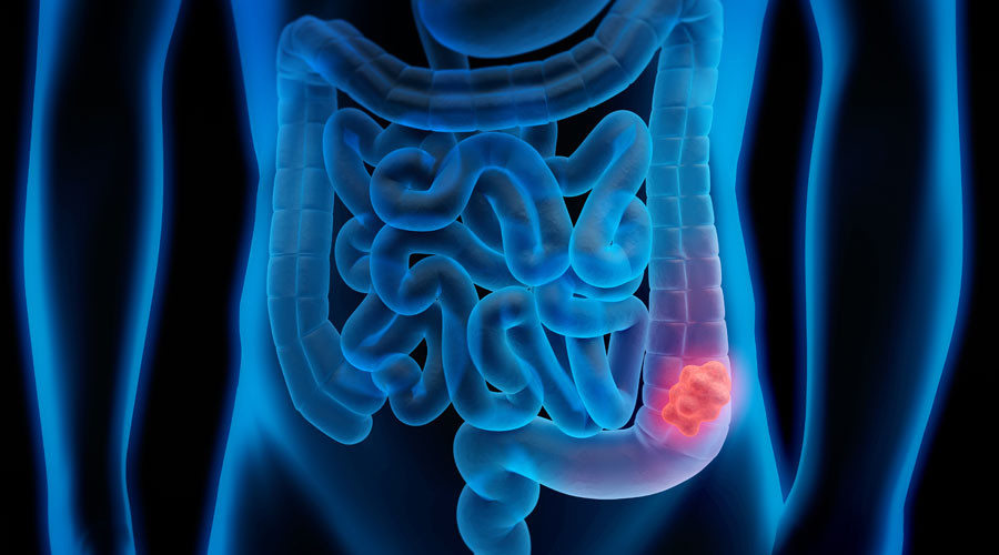 Infografia simulant un càncer de colon