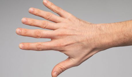 Una persona amb 6 dits a la mà