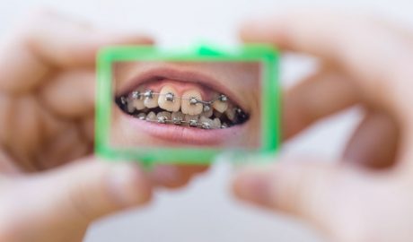 Un noi mirant-se els brackets en un mirall