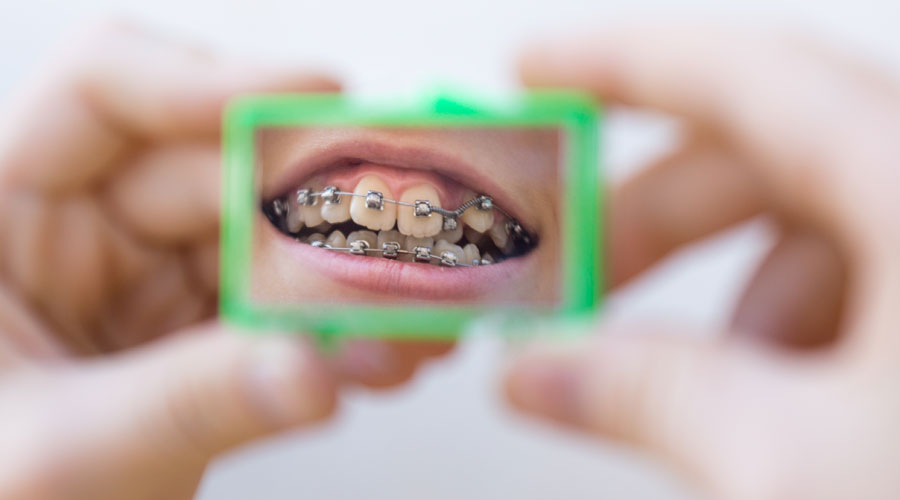 Un noi mirant-se els brackets en un mirall (Getty images)