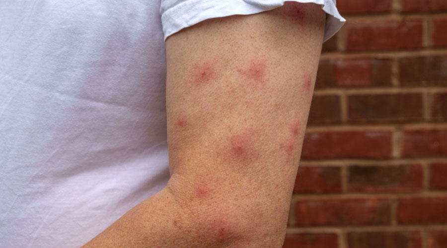 Un braç ple de picades de mosquit (Getty images)