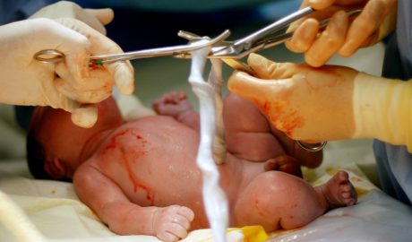 El cordó umbilical a punt de ser tallat