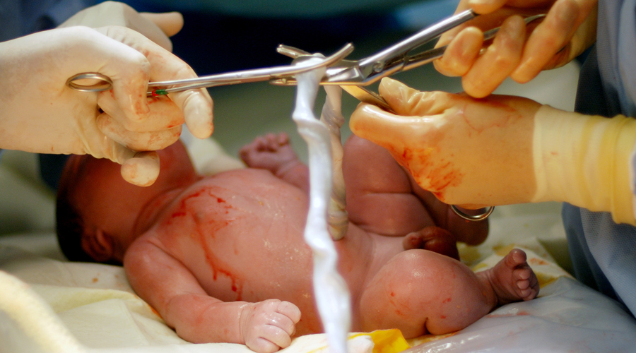 El cordó umbilical a punt de ser tallat (Getty images)