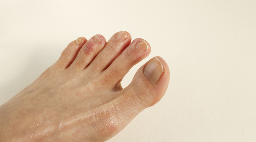 Un peu afectat per penellons (Getty images)