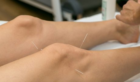 Una persona rebent un tractament d'acupuntura