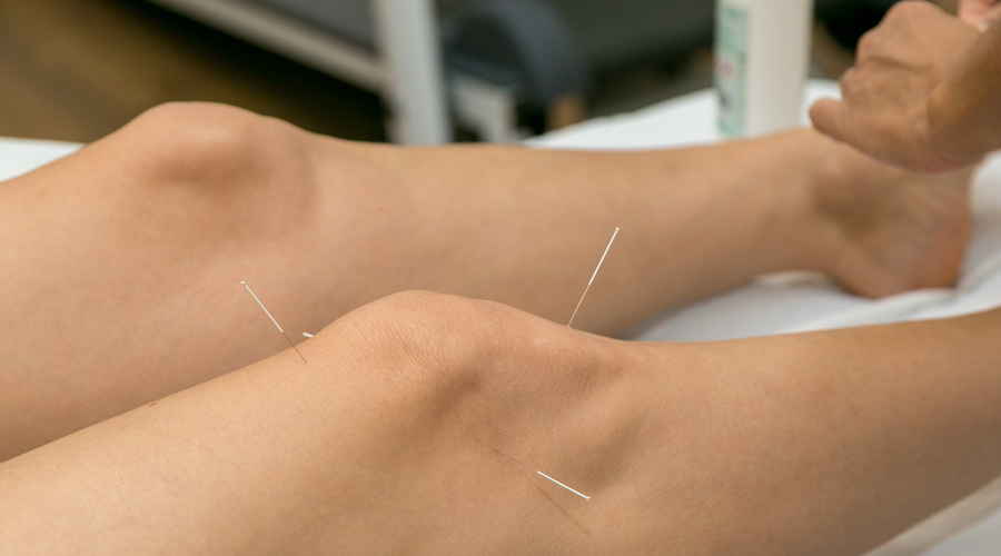 Una persona rebent un tractament d'acupuntura (Getty images)