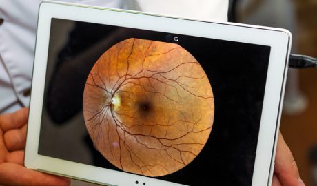 Un glaucoma en un ull