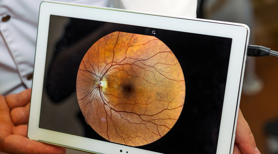 Un glaucoma en un ull (Getty images)