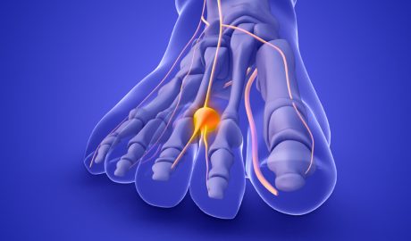 Infografia que indica la malaltia del neuroma de Morton