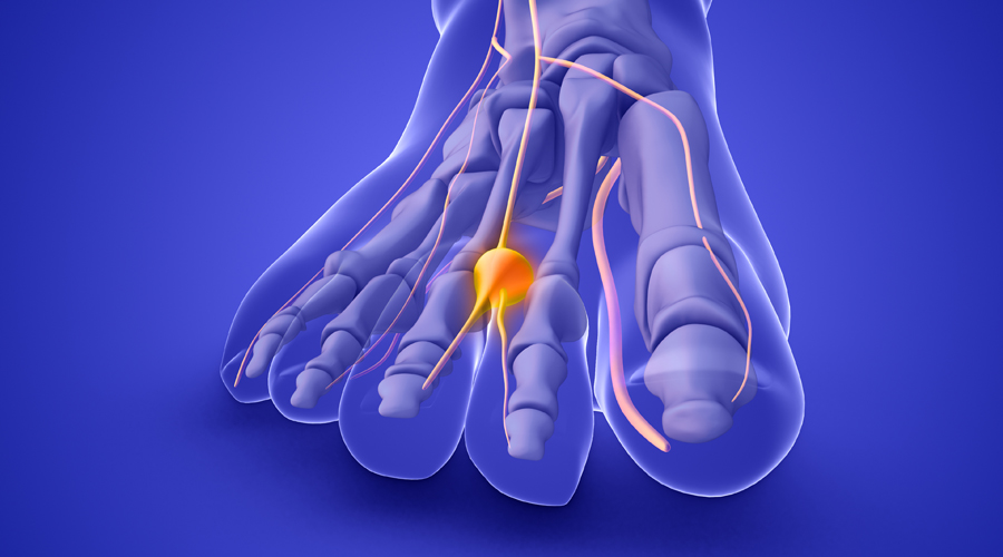 Infografia que indica la malaltia del neuroma de Morton (Getty images)