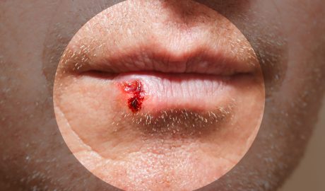 Una persona patint d'herpes labial