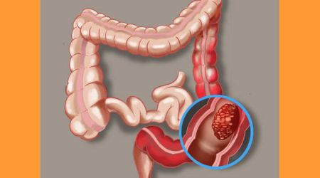 És convenient sotmetre's a la prova per a la detecció precoç del càncer de colon i recte