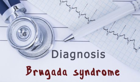 La síndrome de Brugada afecta el sistema elèctric del cor