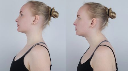 La cifosi fa que l'esquena es corbi excessivament cap endavant