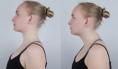 La cifosi fa que l'esquena es corbi excessivament cap endavant