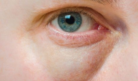 Un ull amb una bossa pronunciada