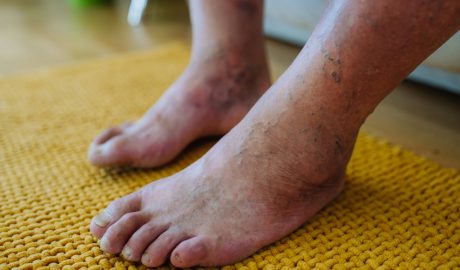 Un home patint de peu diabètic