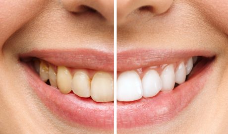 Una boca amb dents groguenques i blanques